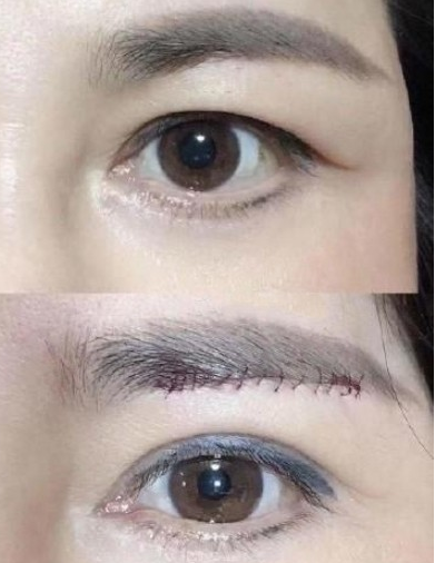 切眉和提眉的区别提眉和切眉的适应症