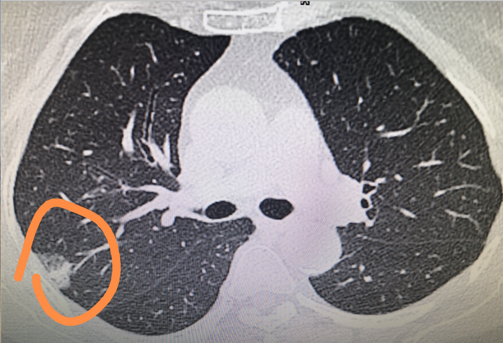 肺部结节 肺部结节