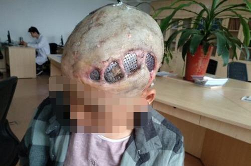 颅骨修补后钛网外露是什么状态_颅骨修补术_颅骨修补