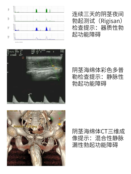 個手術解開他終於可以重振雄風我科開展省內第一例ams700cx型陰莖假體