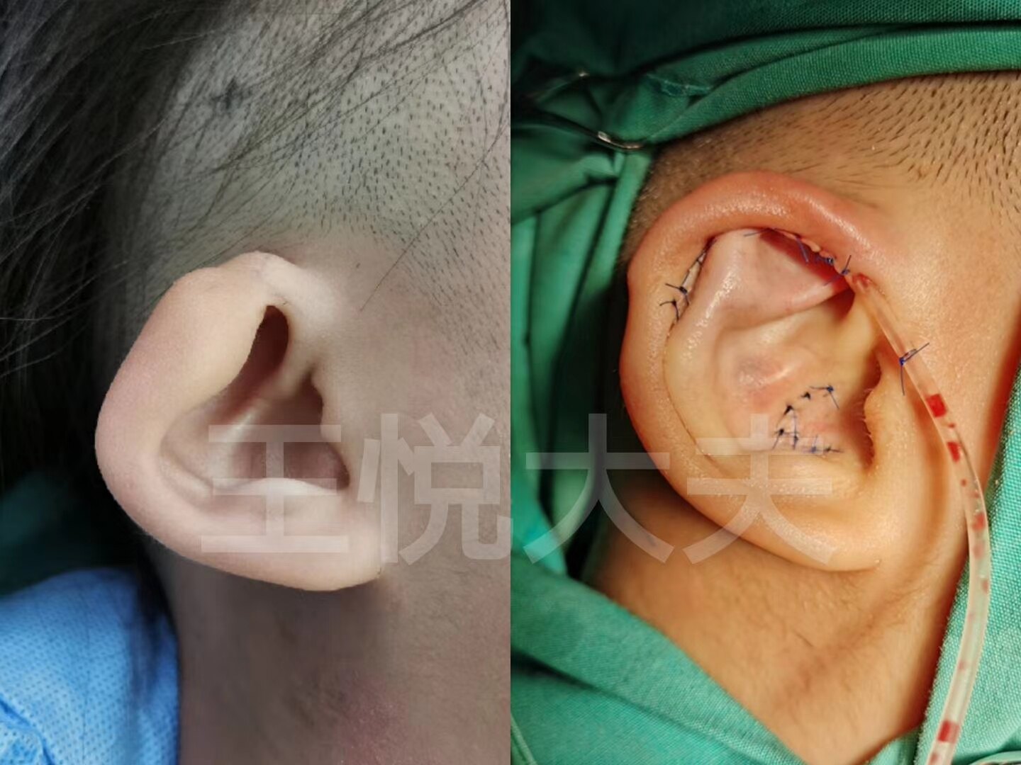 先天性耳朵畸形治疗图片