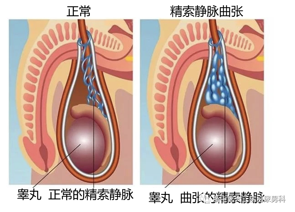 精索静脉曲张