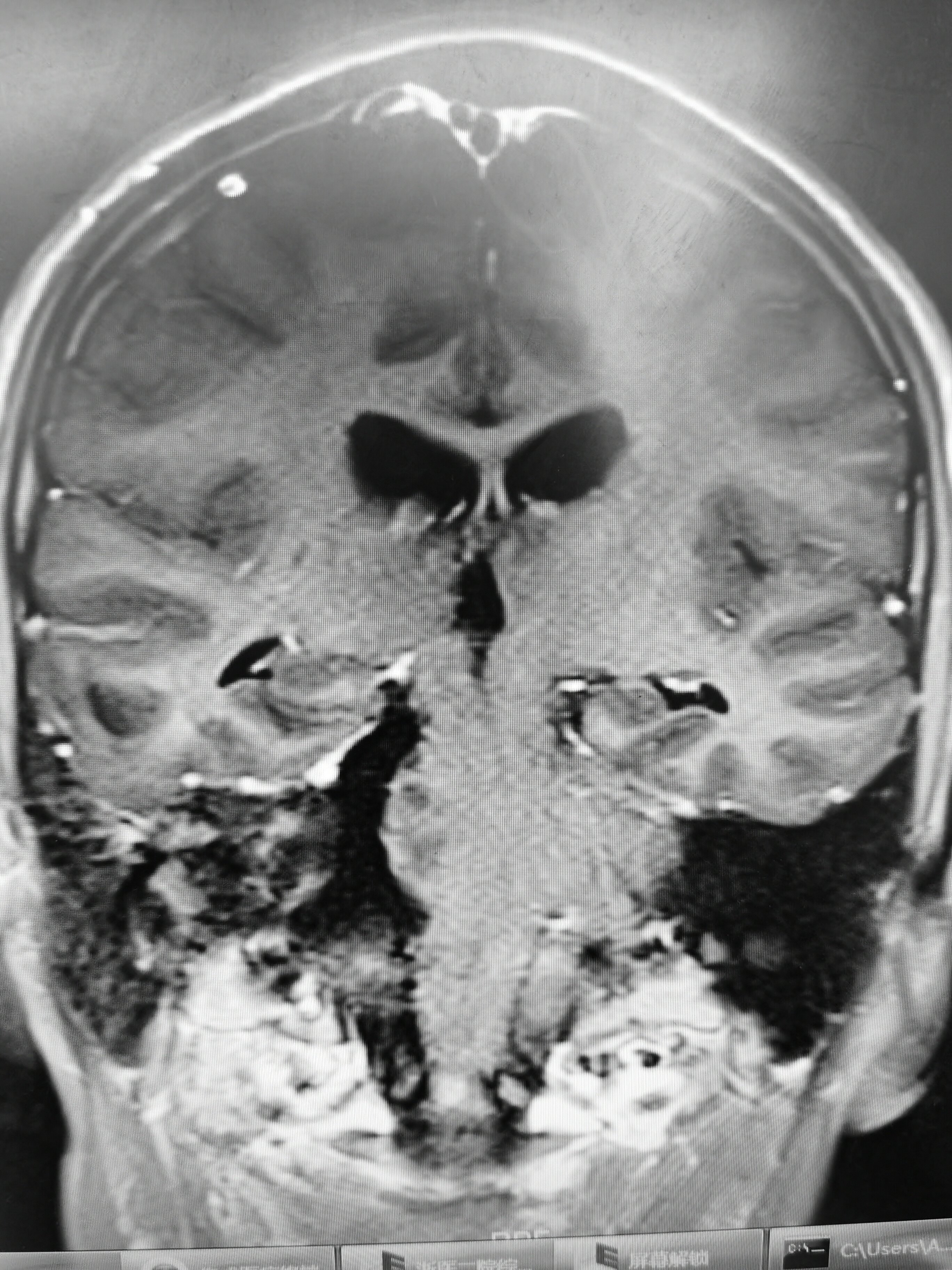16岁巨大听神经瘤 - 好大夫在线
