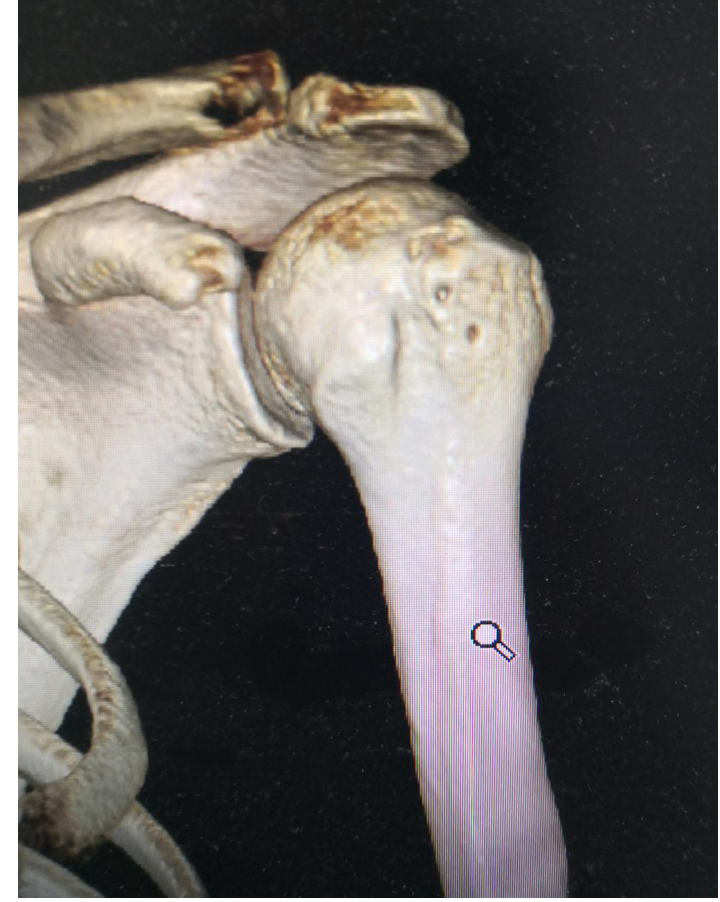 微创髓芯减压植骨术治疗早期肱骨头坏死_骨坏死_介绍_发病原因 - 好