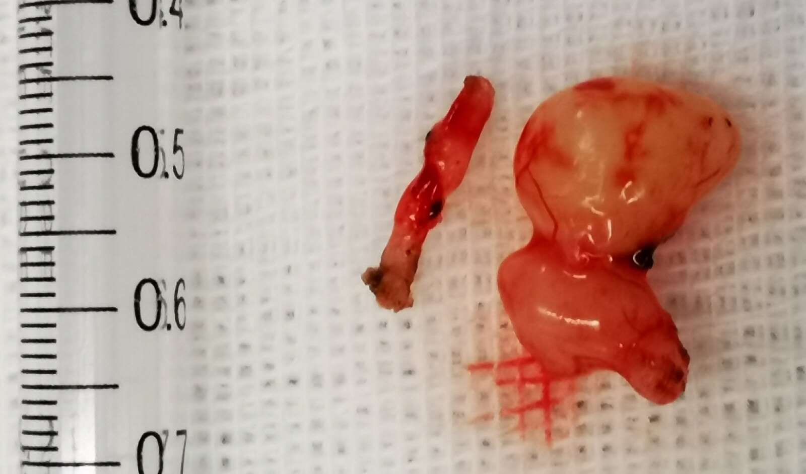 一例Ⅱ型神经纤维瘤病患者的5次手术治疗(二) - 好大夫在线