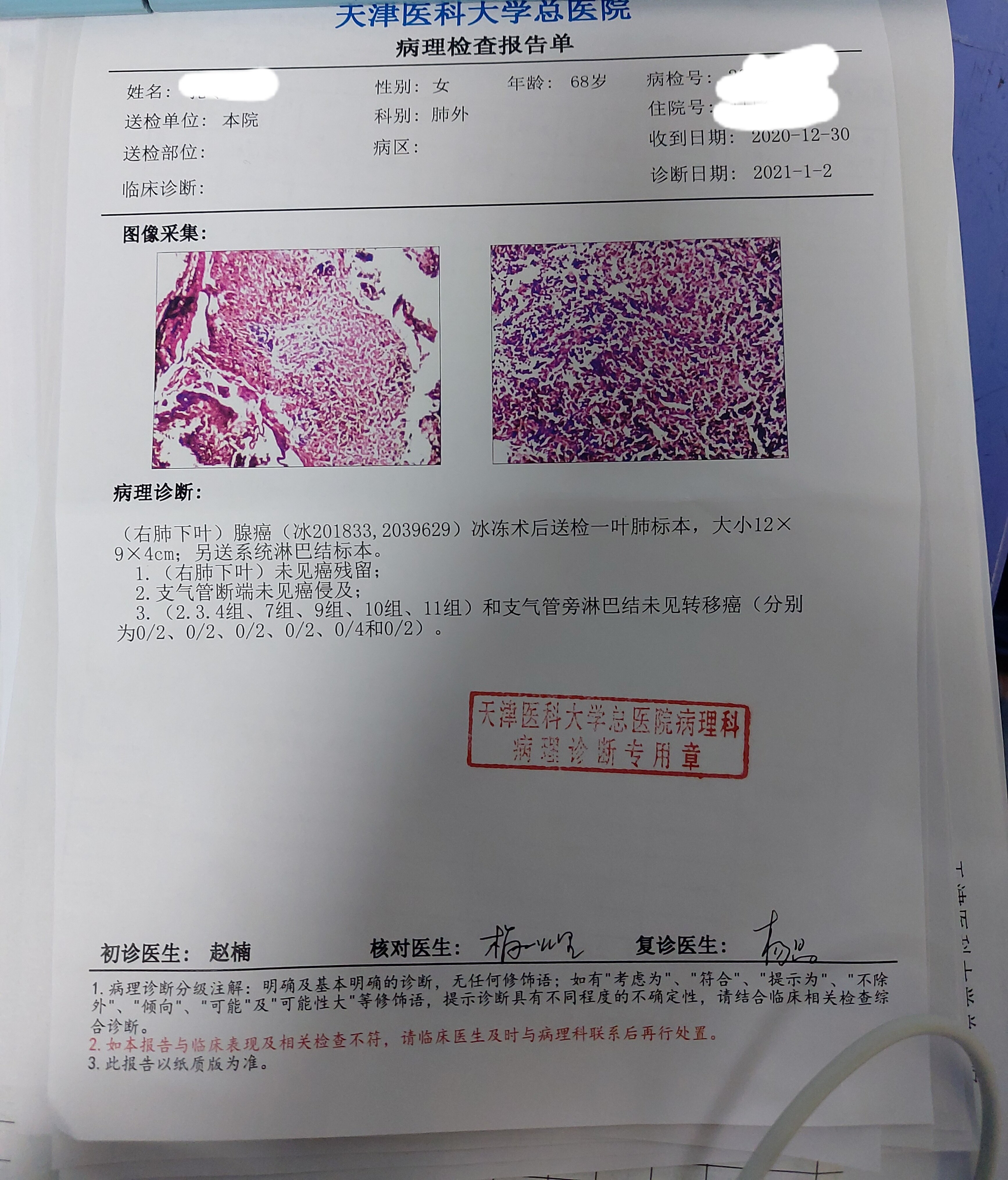 肺癌病理报告 模板图片
