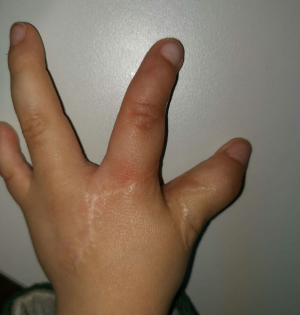 擅長(zhǎng):顏面骨外傷及面部輪廓整復(fù)、鼻唇畸形整復(fù)、手部燒創(chuàng)傷急救及先天后遺畸形治療與功能重...黃牛號(hào)販子掛號(hào)_10分鐘搞定,快的讓你不可思議的簡(jiǎn)單介紹 擅長(zhǎng):顏面骨外傷及面部輪廓整復(fù)、鼻唇畸形整復(fù)、手部燒創(chuàng)傷急救及先天后遺畸形治療與功能重...黃牛號(hào)販子掛號(hào)_10分鐘搞定,快的讓你不可思議的簡(jiǎn)單介紹