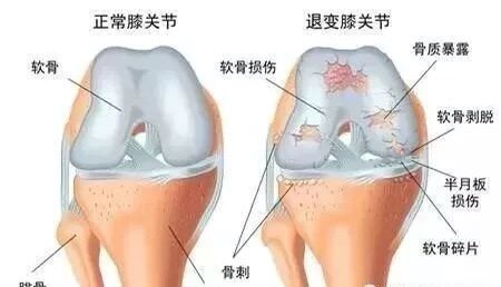 膝关节疾病之骨性关节炎