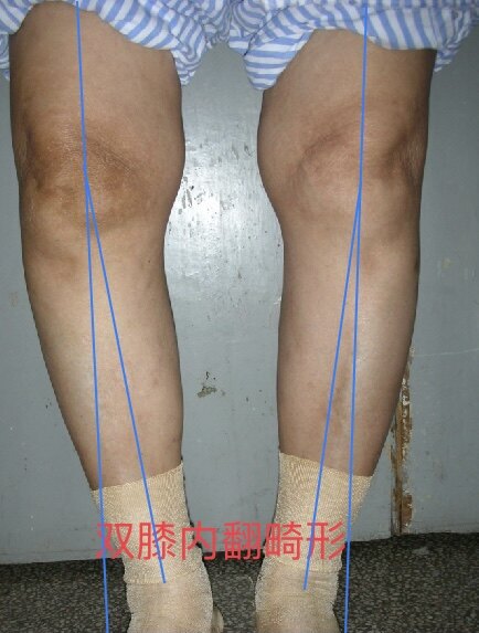 膝盖疼男生_男性膝盖疼痛可能有三种病_男性膝盖疼是缺钙吗