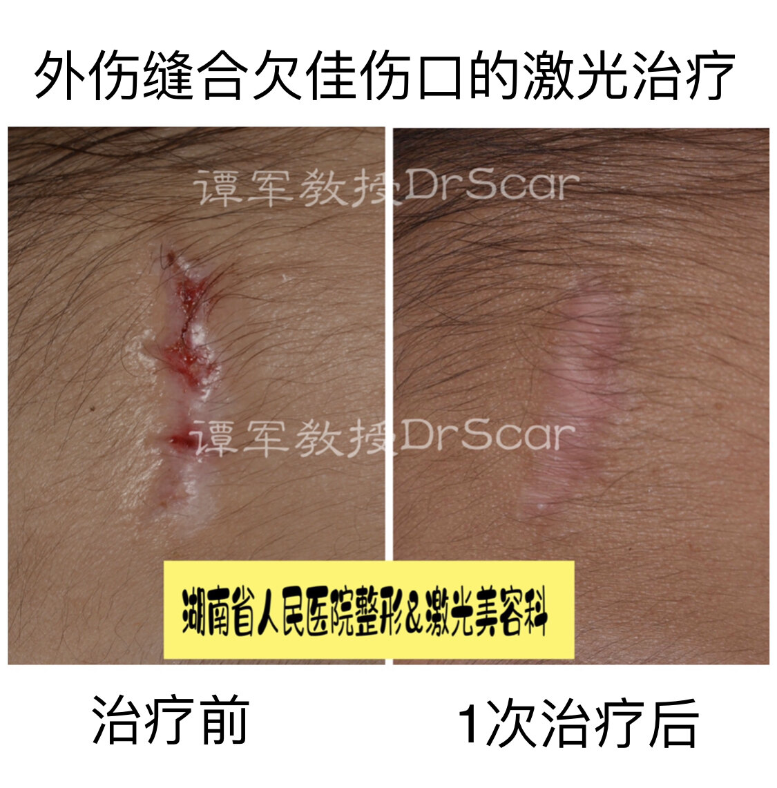 愈合不良的伤口 是二期缝合还是激光治疗 激光美容 好大夫在线 愈合不良的伤口 是二期缝合还是激光治疗 激光美容 好大夫在线