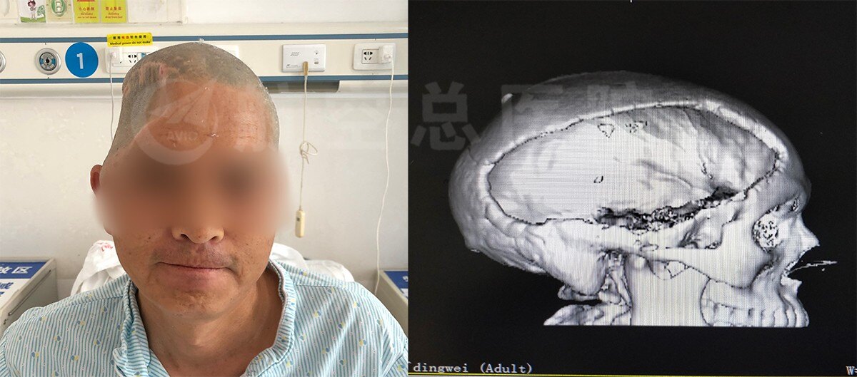 航空总医院穆苍山团队peek颅骨修复整形帮男子恢复头颅原貌