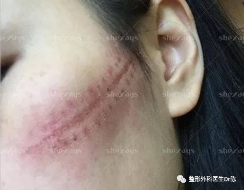 强,目测会对皮肤造成切割伤和压迫伤,导致最终拆线后形成蜈蚣足样疤痕