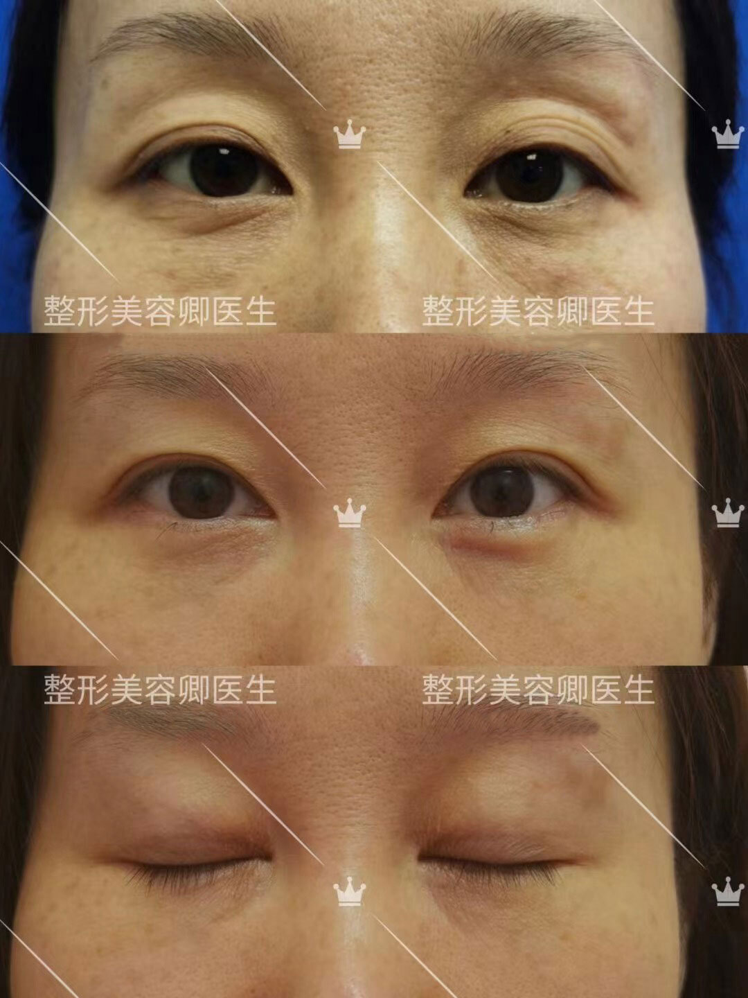 郭鑫医生眼袋手术案例二：外切眼袋去除术（下眼睑除皱） - 好大夫在线