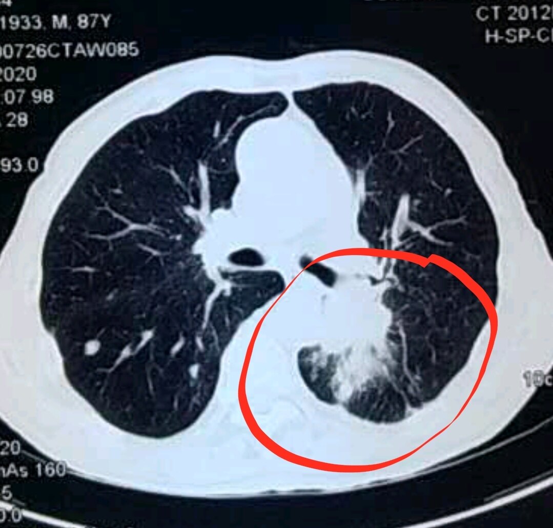 但都以外周型肺結節為主,但87歲的中央型肺癌的治療確實沒有經驗,高齡