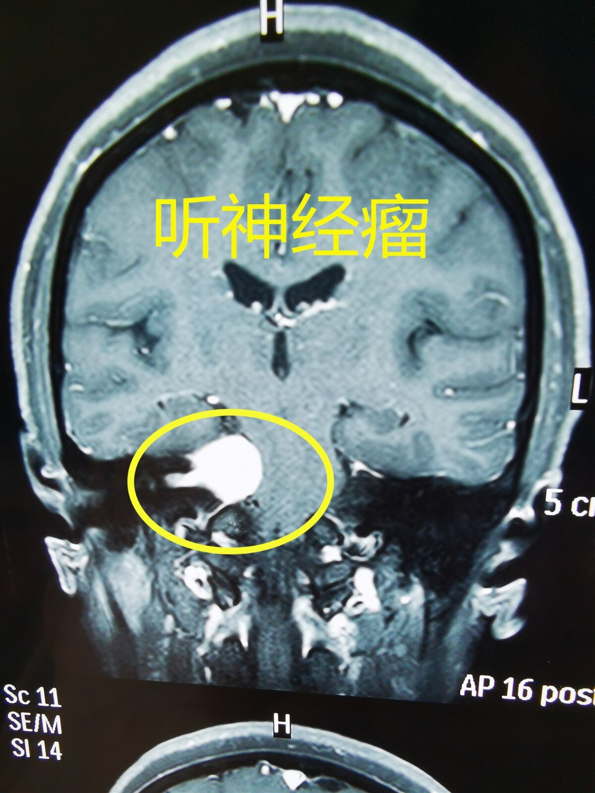 聽神經瘤手術面神經保留完好,為什麼術後也會出現面癱?