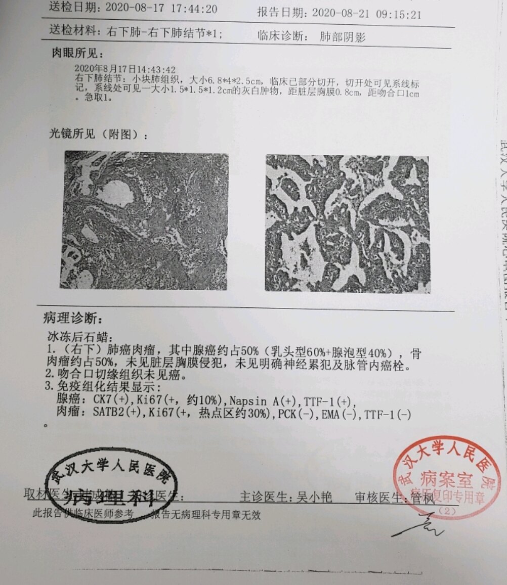 刘懿博士说肺癌 一亖八七 这例肺结节的癌症 我还是第一次见 肺癌 刘懿博士说肺癌 一亖八七 这例肺结节的癌症 我还是第一次见 肺癌