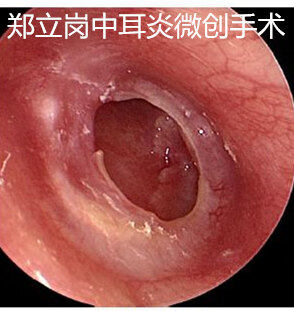 鼓膜大穿孔 手术成功率高吗 鼓膜穿孔 鼓膜穿孔