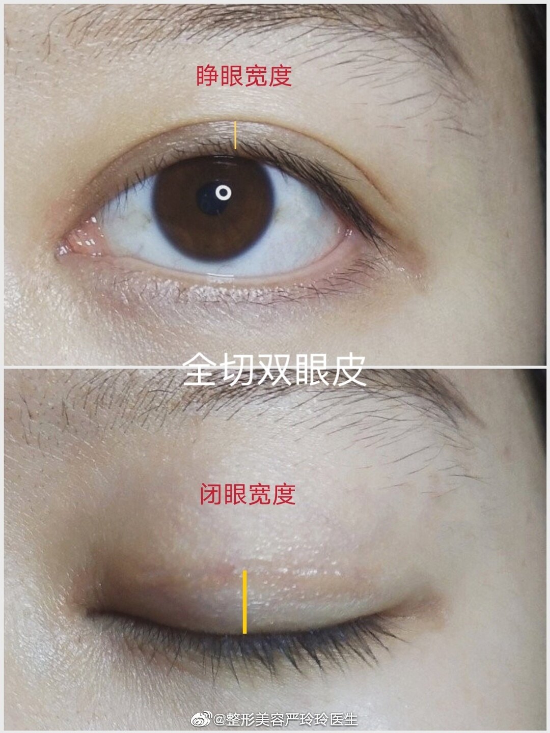 求美者面诊时常常会要求双眼皮宽度,例如65mm,7mm,75mm等