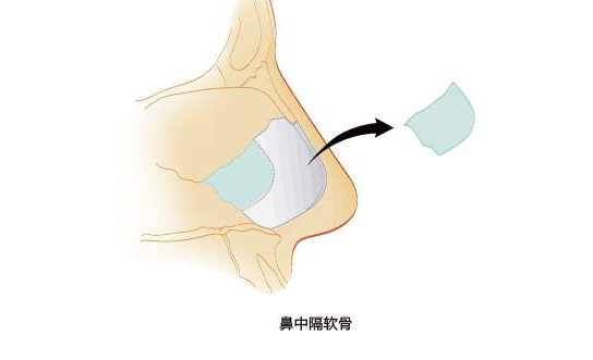 为什么不建议取鼻中隔软骨来做隆鼻手术?