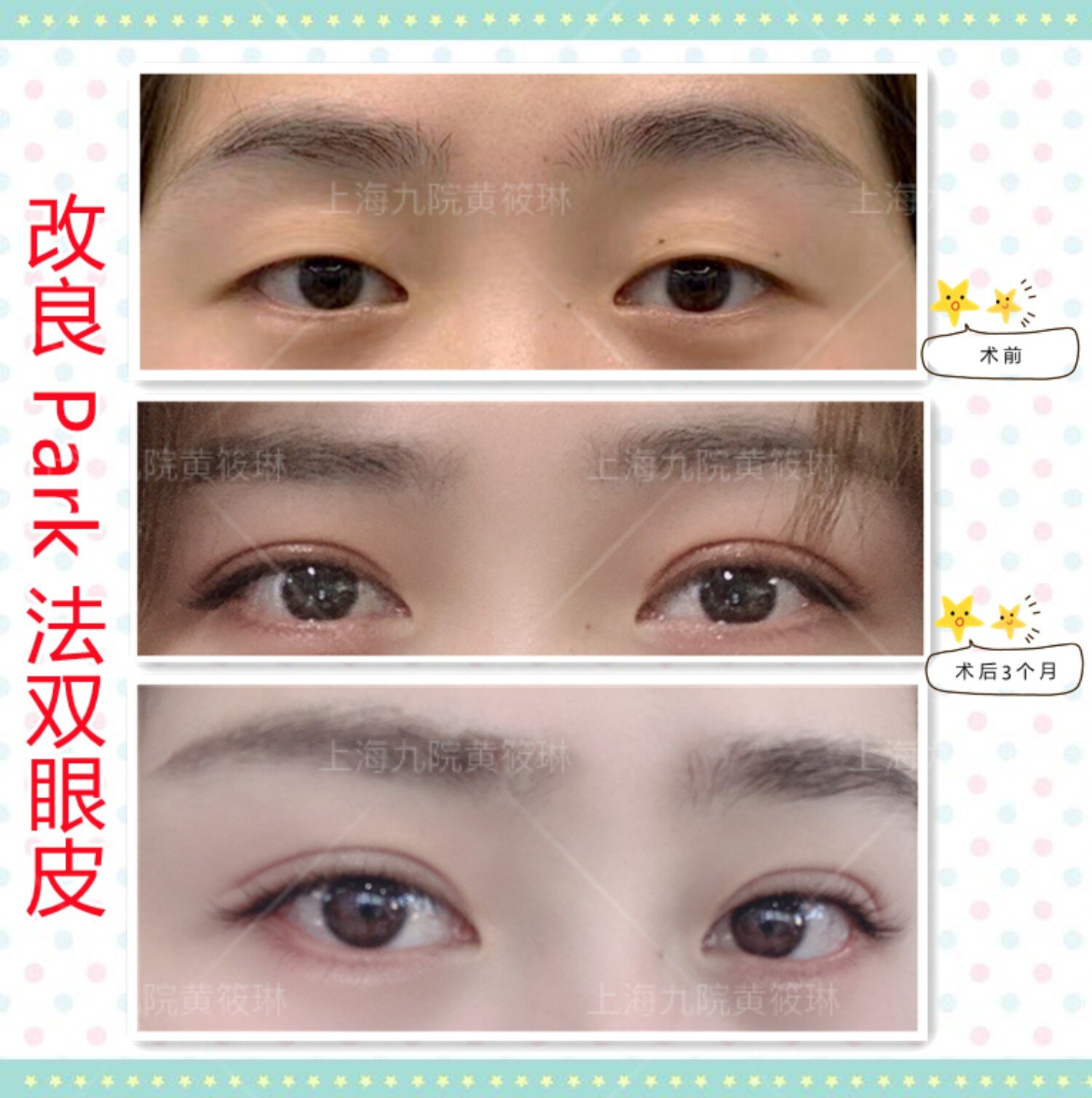 上海九院黄筱琳改良park法双眼皮案例分享1