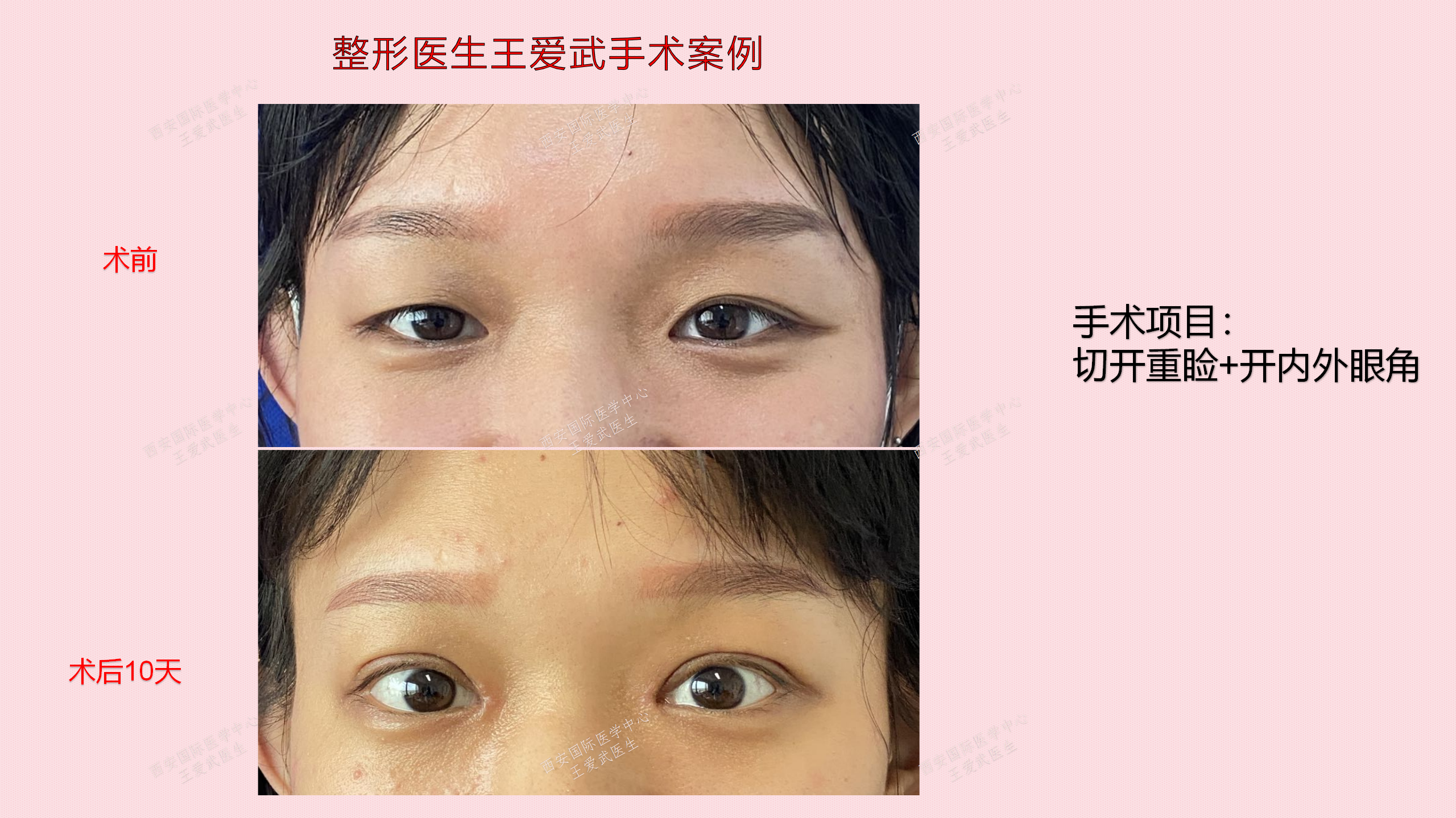 切开重睑 开内外眼角 - 好大夫在线