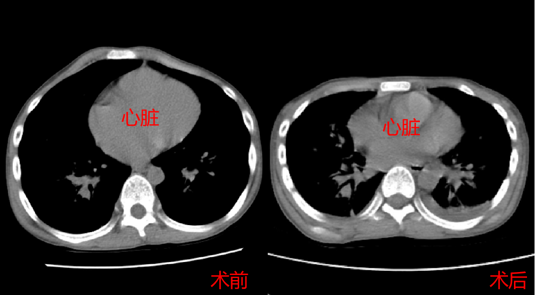 鸡胸诊断图片