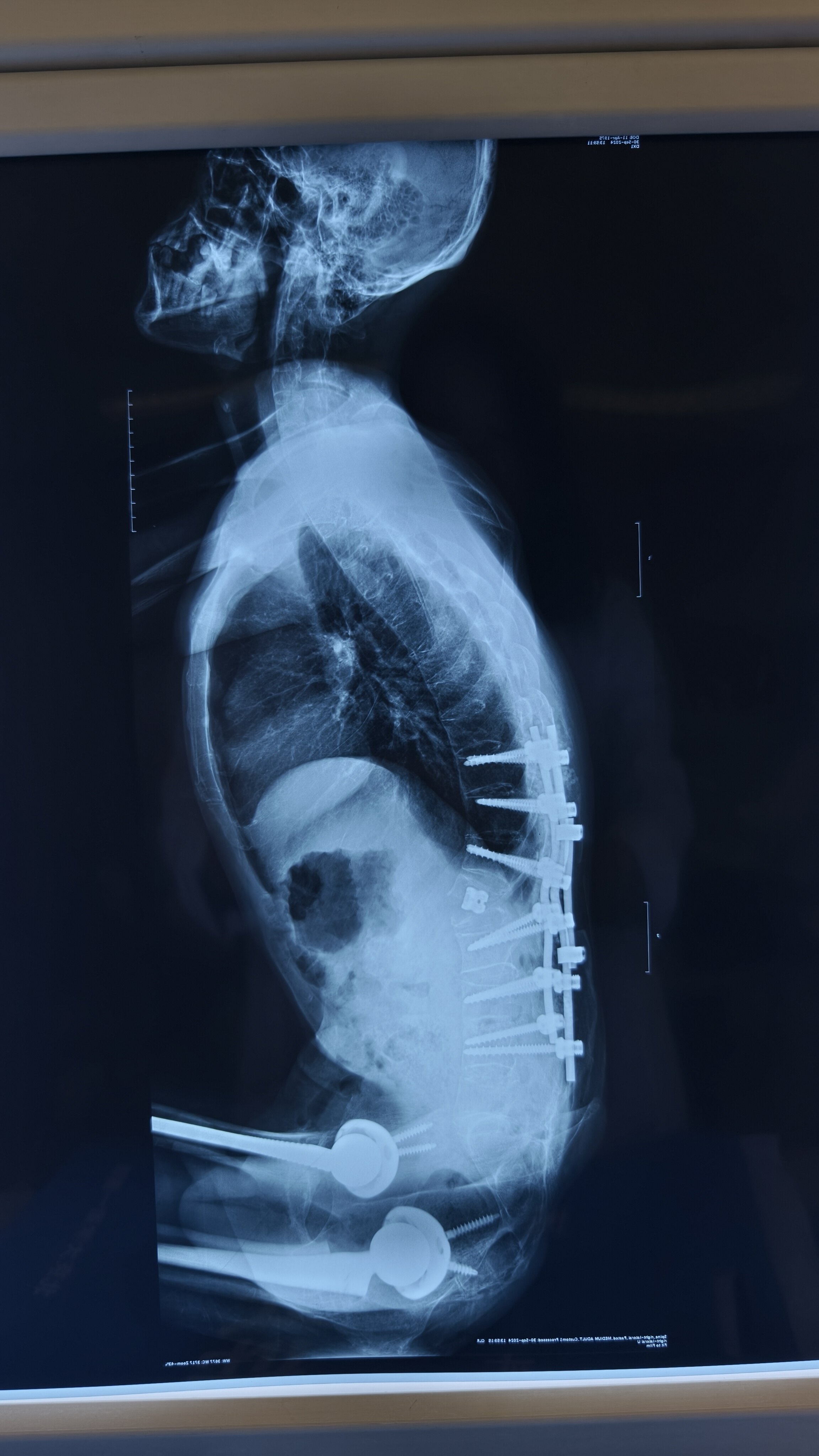 重度强直性脊柱炎治疗案例