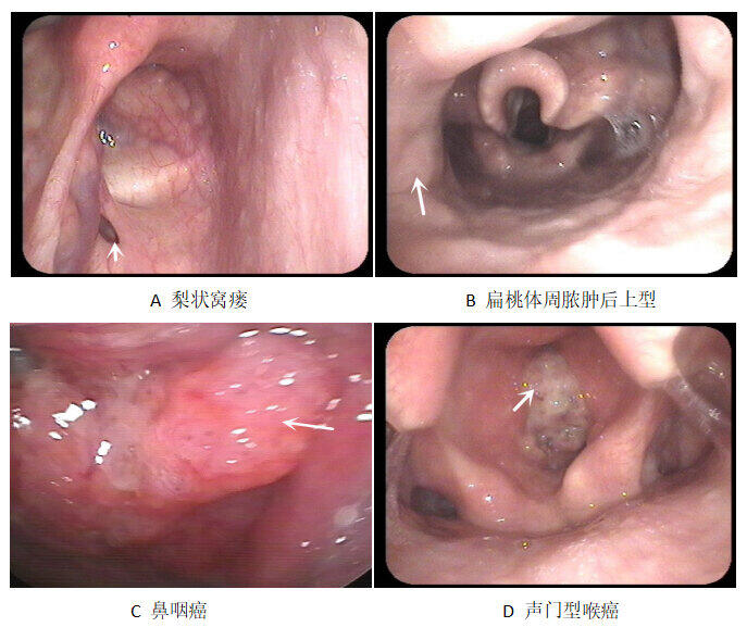 鼻咽癌.jpg