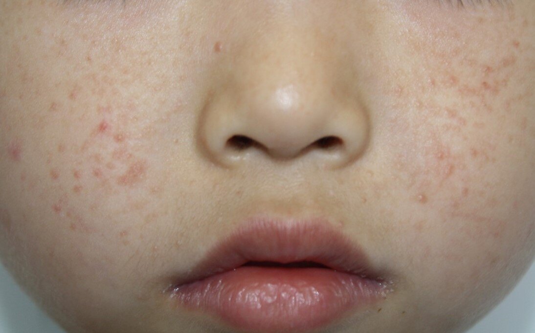 面部黑色素瘤能治愈吗_颜面部黑色素瘤_面部黑色素瘤扩散症状