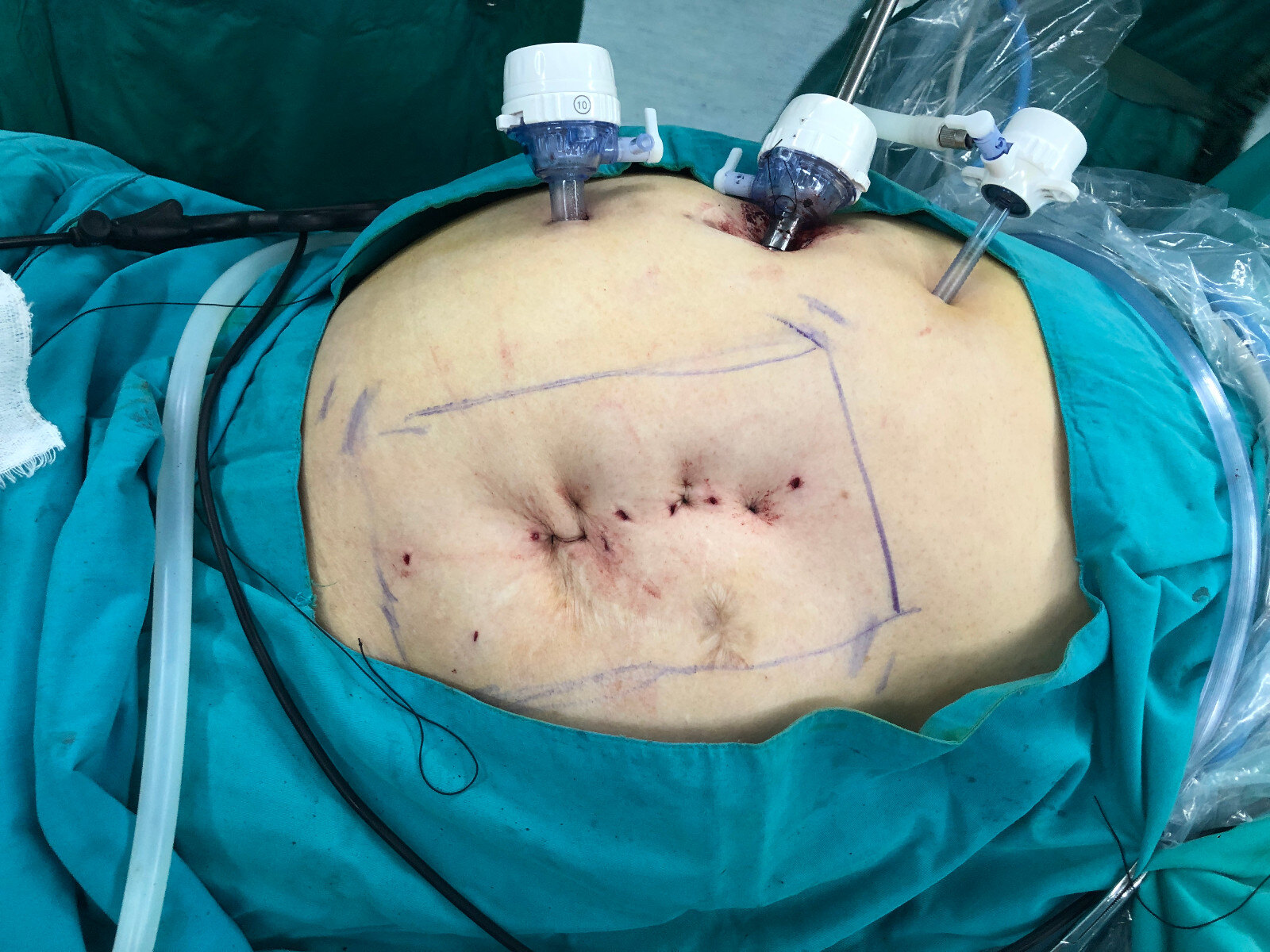 普外科成功完成一老年巨大腹壁切口疝手术 