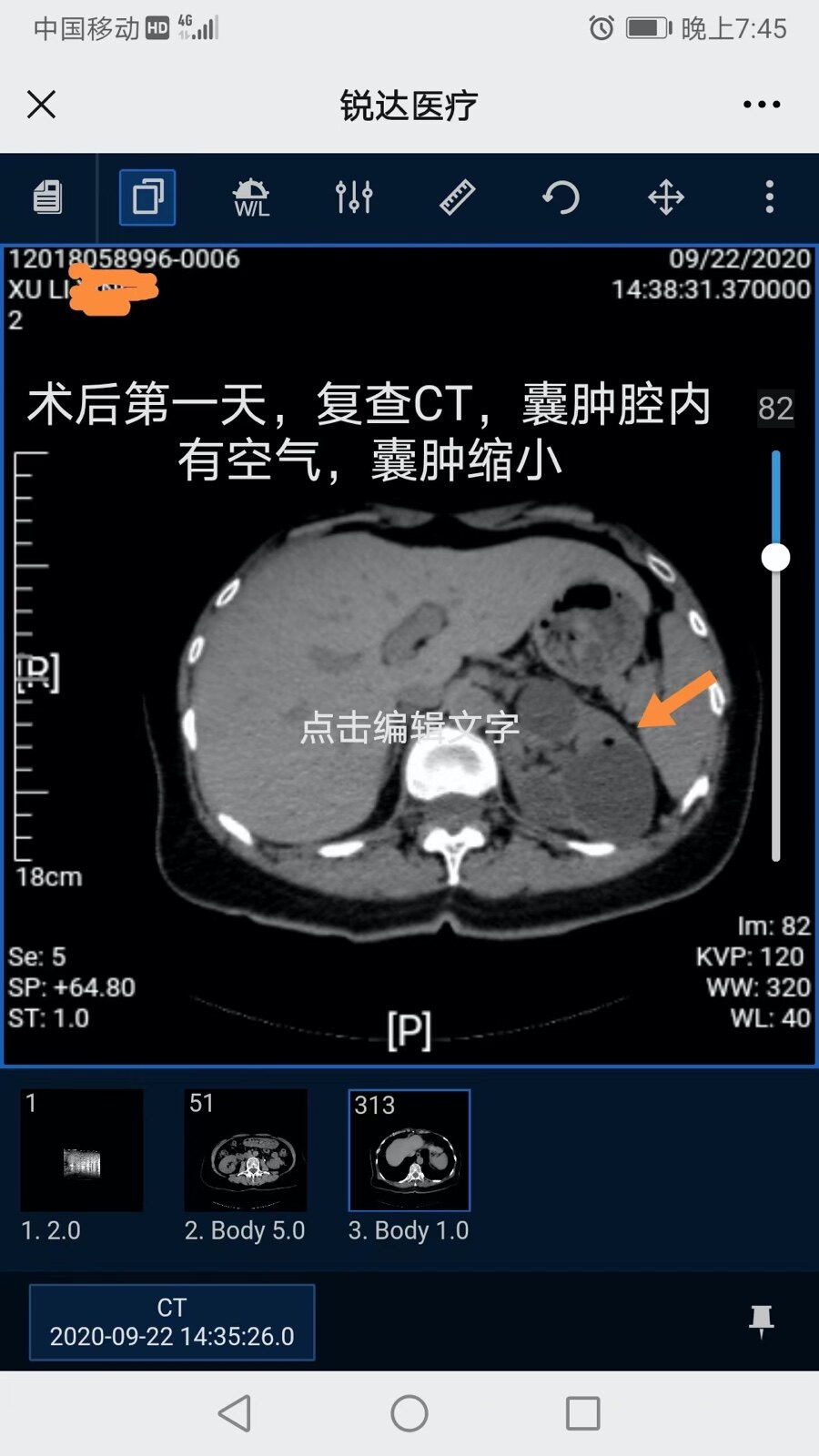 輸尿管軟鏡引導下激光腎囊腫內切開引流-典型病例1