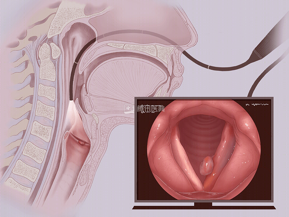 声带息肉-腾讯医典.png