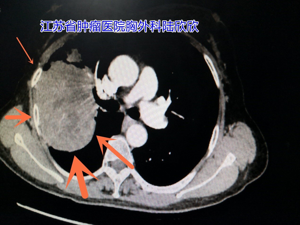 黑龙江巨大<!--HAODF:8:feiai-->肺癌<!--HAODF:/8:feiai-->2水印.jpg