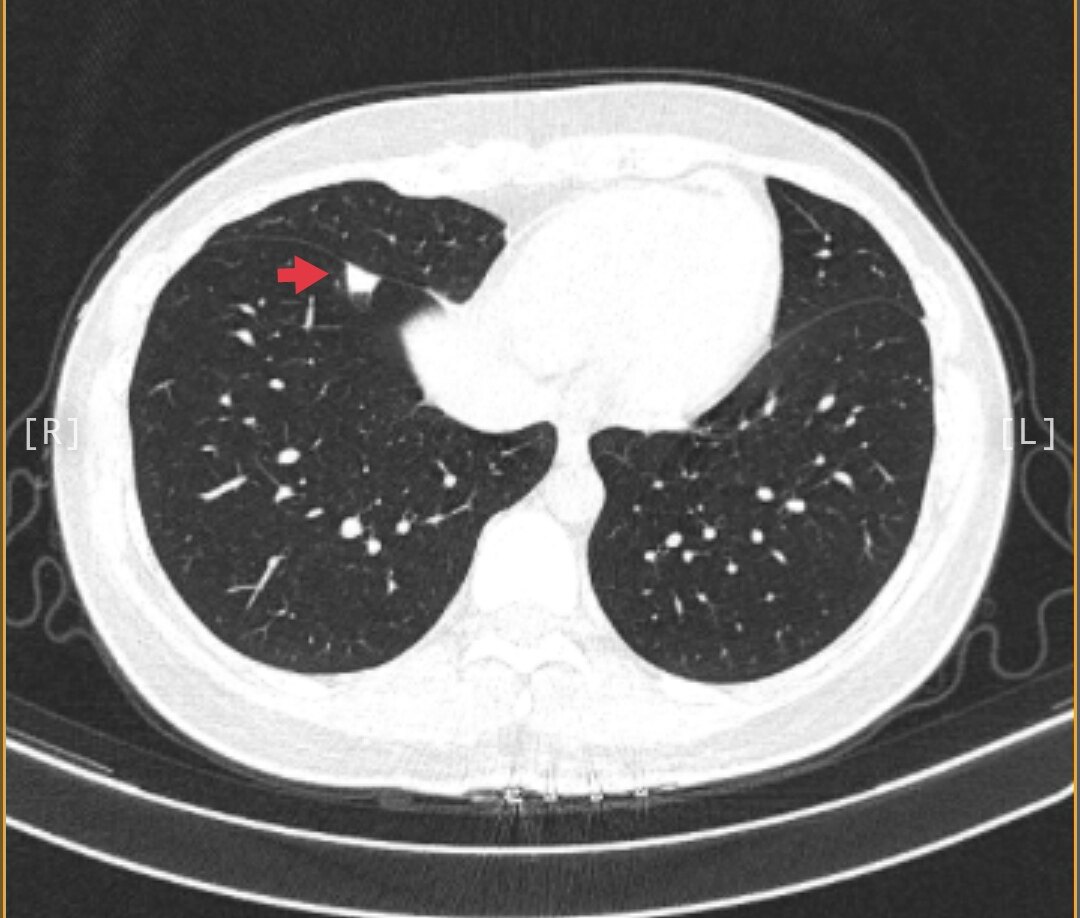 肺结节的片子图像图片