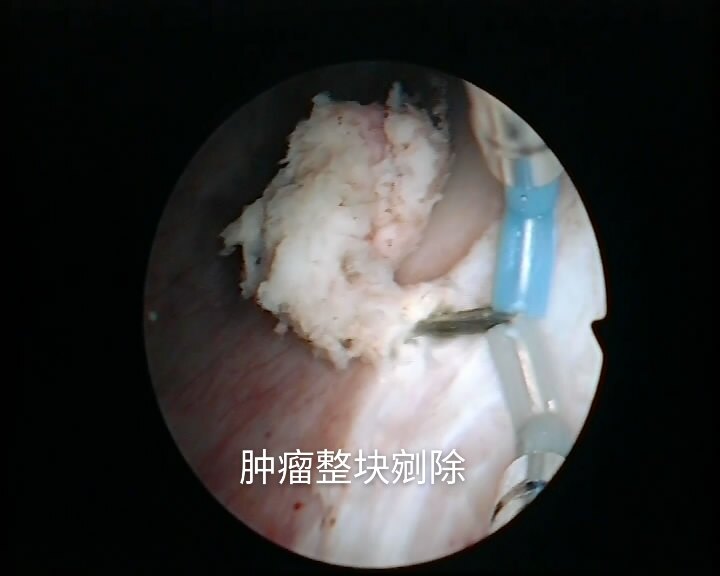 膀胱癌_膀胱癌治疗方式 - 好大夫在线