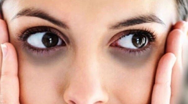 黑眼圈在专业上称为眶周色素沉着过度,它是我们眼睑周围皮肤呈现