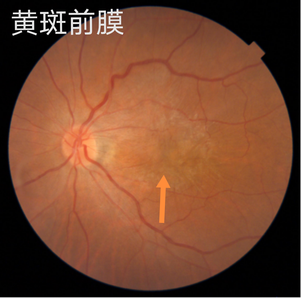 下面两图分别为黄斑前膜的眼底照相及黄斑oct检查报告2
