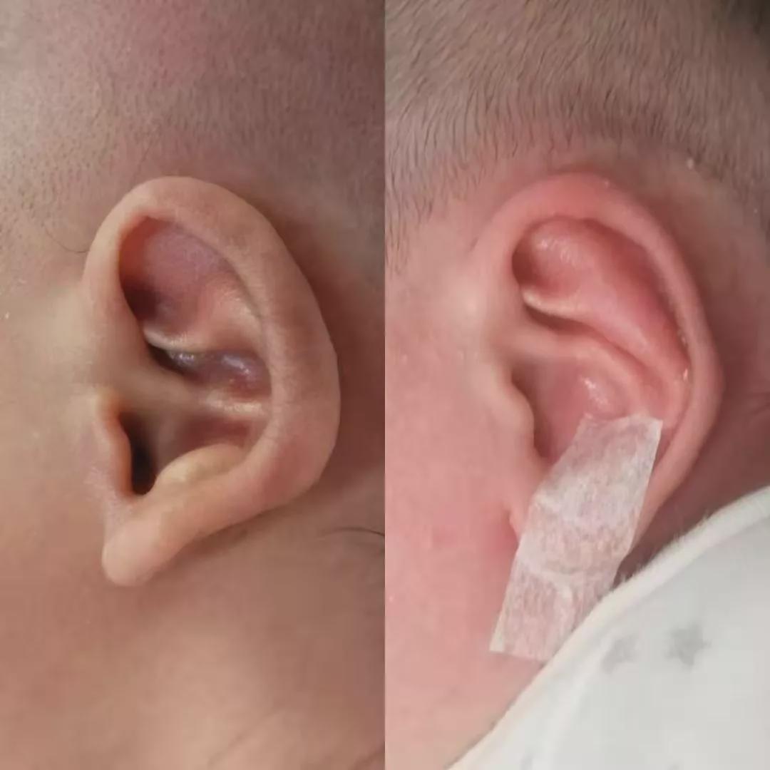 新生儿耳廓畸形,宝爸宝妈们常常忽视而错过了最佳治疗时间