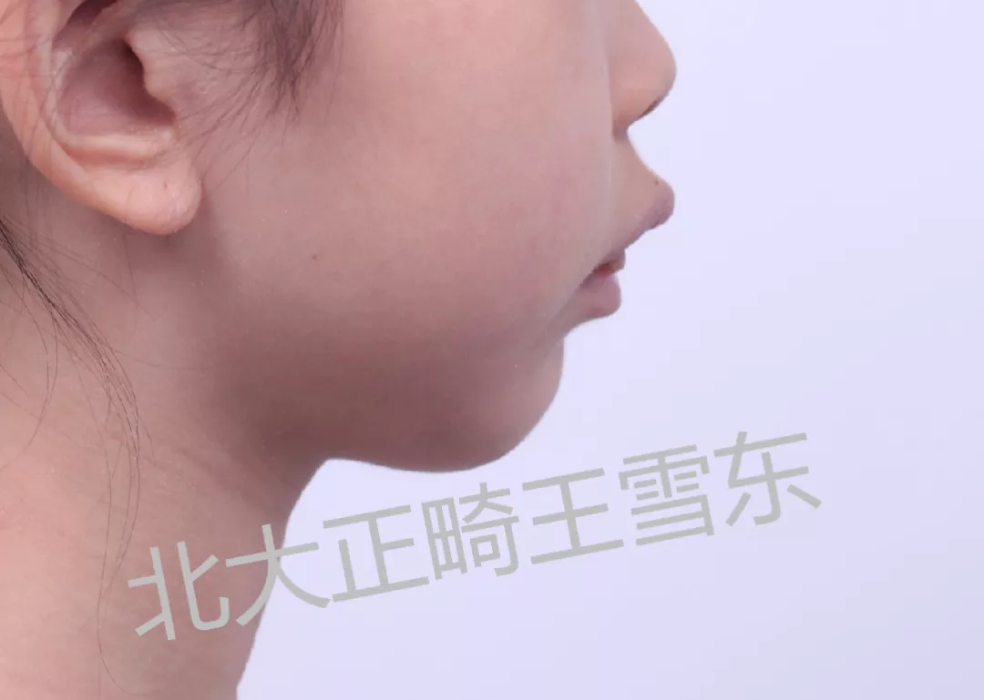 孩子牙齿不齐咬合不好最佳矫正治疗时机是