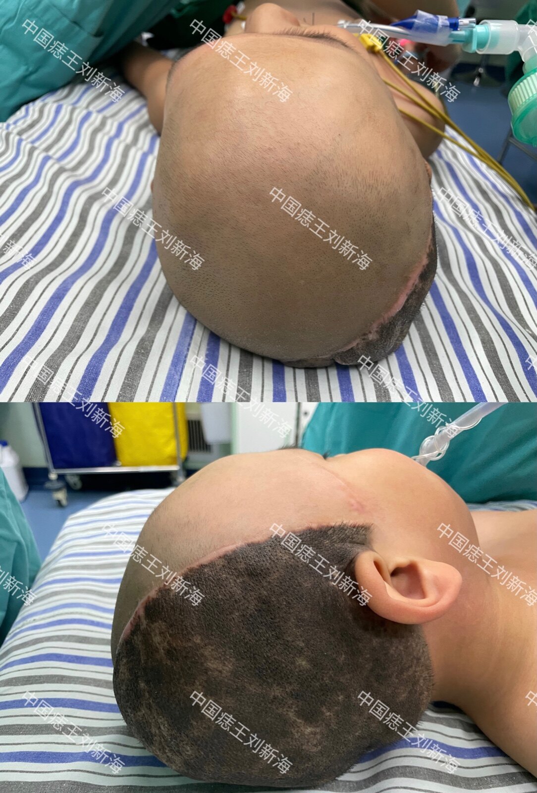 头皮大面积黑痣扩张手术效果 - 好大夫在线