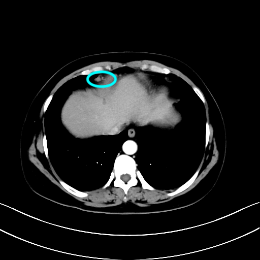 妇科一病区完成一例心膈角淋巴结切除术(2020年11月) - 好大夫在线