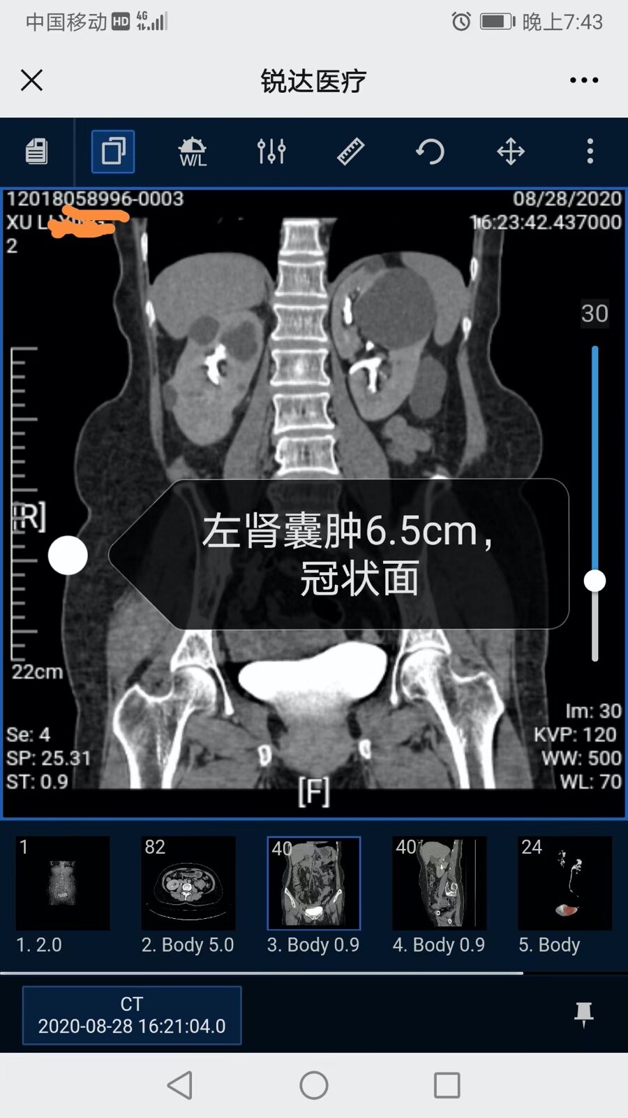 輸尿管軟鏡引導下激光腎囊腫內切開引流-典型病例1 - 好大夫在線