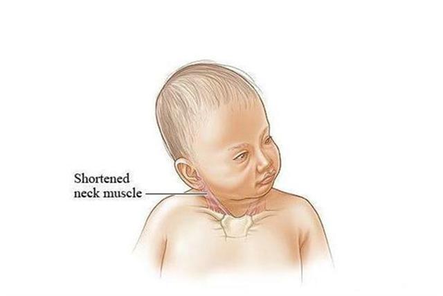 脊髓灰质炎后遗症是什么步态_脊髓灰质病毒 包膜_脊髓灰质前角后角