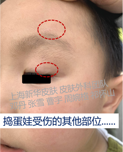 疤痕_相关疾病_如何预防 - 好大夫在线