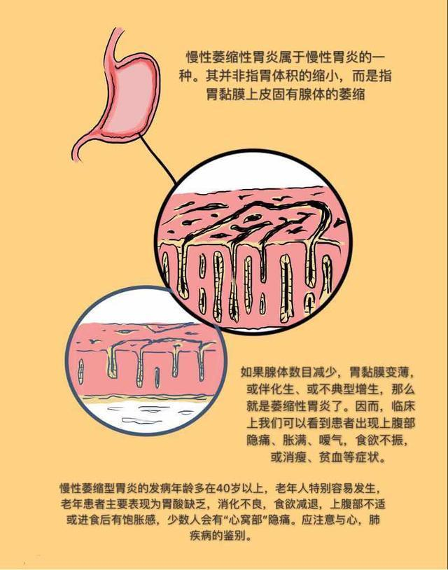 查出慢性萎缩性胃炎,饮食做到这几点,避免病情加重_慢性萎缩性胃炎