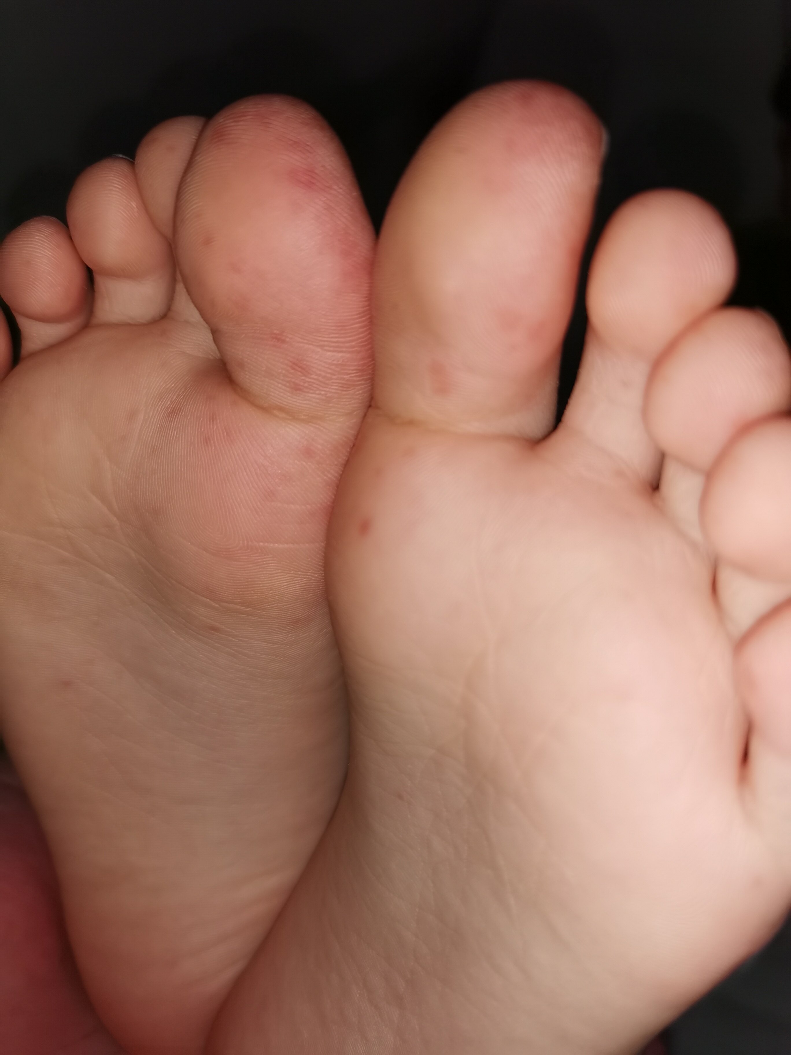 手足口初期疹子图片图片