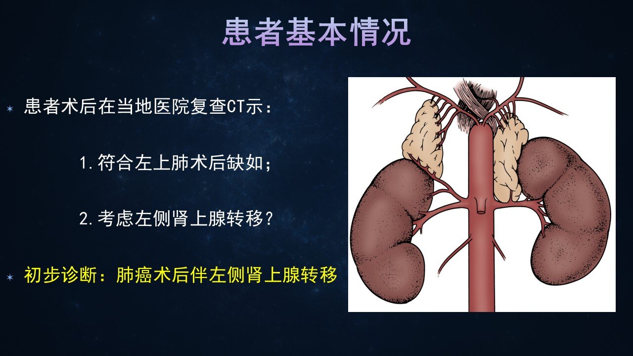典型病例1:左侧肾上腺肿瘤(肺癌术后出现肾上腺转移) - 好大夫在线