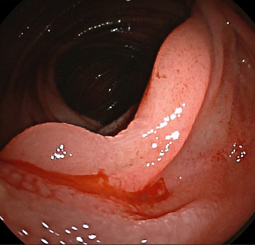 胃镜胃出血图片图片