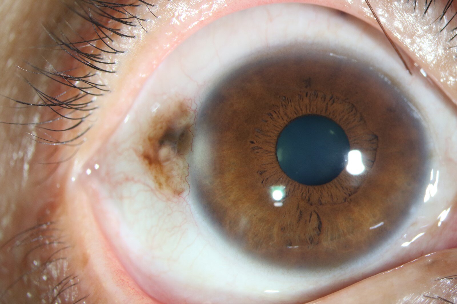 后葡萄膜炎——17、急性视网膜色素上皮炎 - 知乎