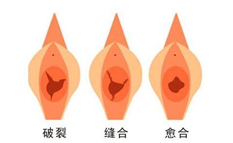 外阴整形_外阴整形治疗介绍 - 好大夫在线